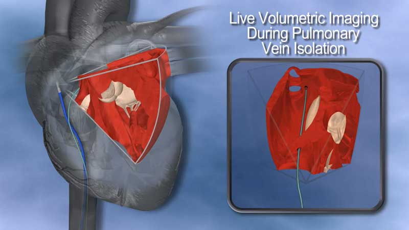 Illustration of RTI’s Live Volumetric Imaging device being used in a procedure called pulmonary vein isolation